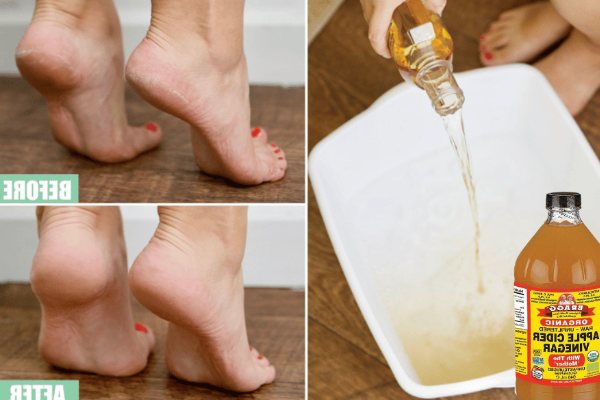 Apple Cider Vinegar on Feet for Weight Loss
