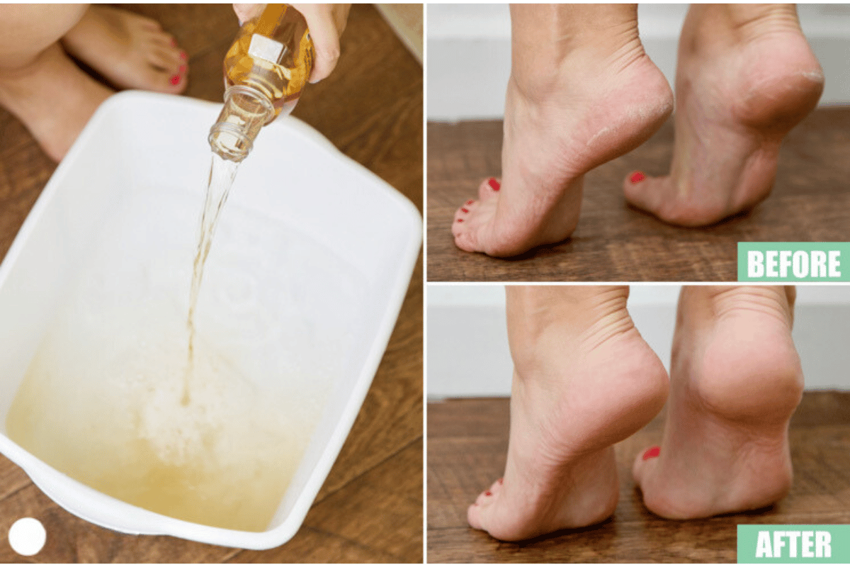 apple cider vinegar on feet weight loss